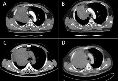 NUT Carcinoma of the Lung：A Case report and Literature Analysis
